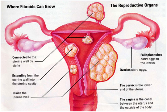Fertilité féminine thé fibroïde sachet de thé à base de plantes usine  utérus thé